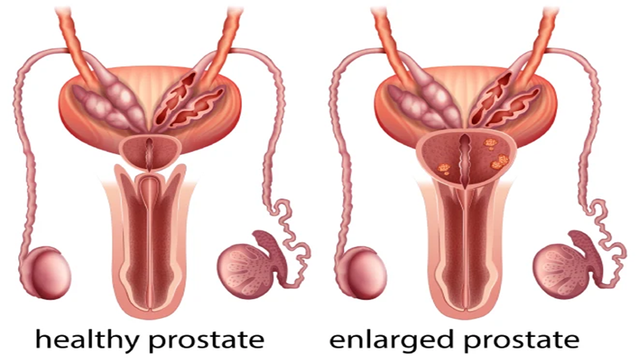 Emerging Technologies in Diagnosis and Treatment of Prostate PBH and Cancer